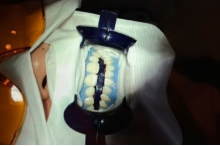 ホワイトニング施術